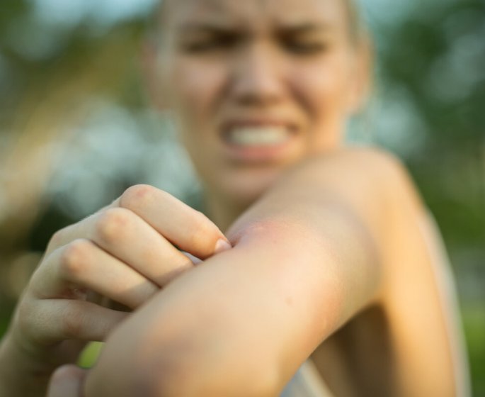 Abeille, tique, araignee… Un pharmacien explique comment savoir quel insecte vous a mordu ou pique