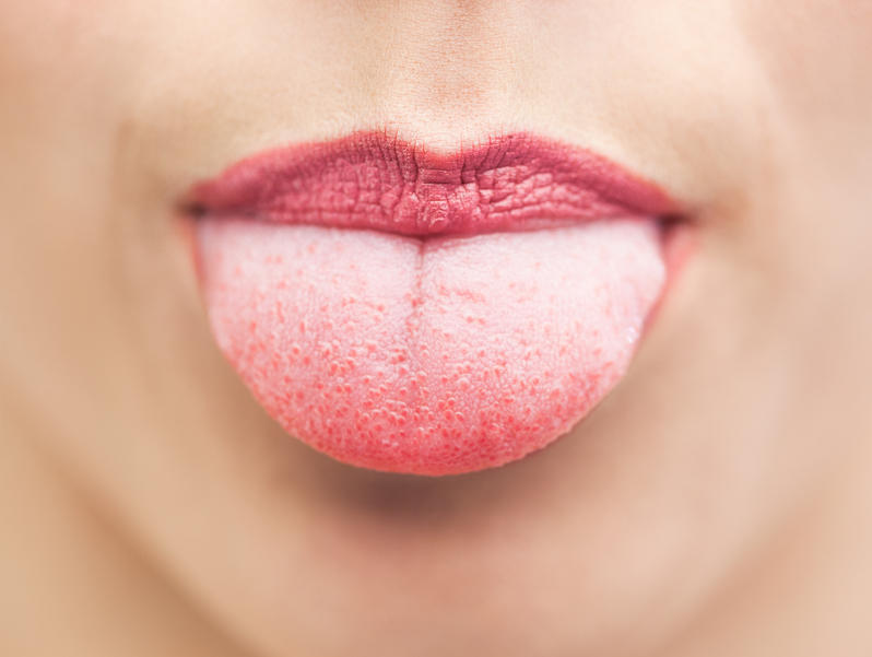 Aphte sur la langue : comment l'enlever | Medisite