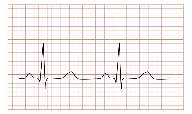De l&apos;électrocardiogramme ou ECG :