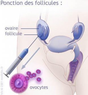 Étape 2 : le recueil des ovules et des spermatozoïdes