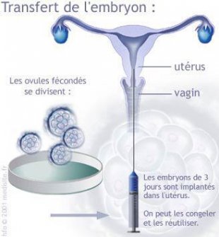 Étape 4 : le transfert des embryons dans l&apos;utérus