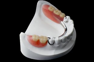 Les appareils dentaires partiels ou stellites