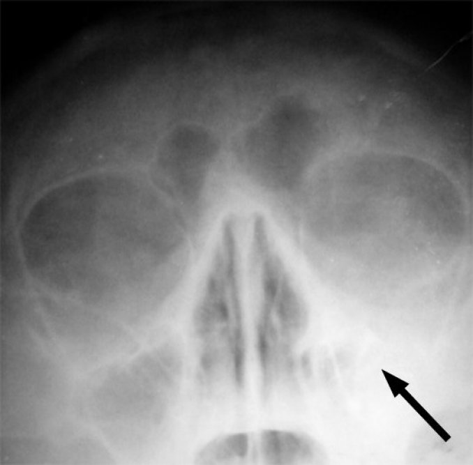 Photo : radiographie d&apos;une sinusite maxillaire gauche marquée d&apos;une flèche