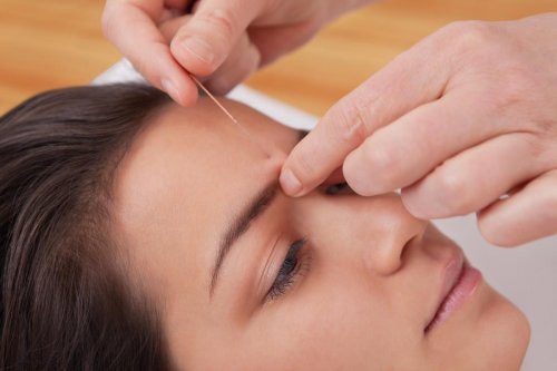 Tentez l&rsquo;acupuncture contre les migraines