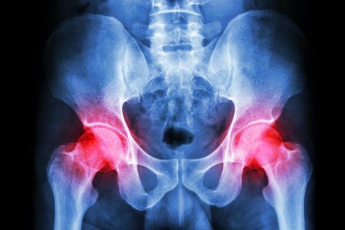 Des malformations congénitales des hanches