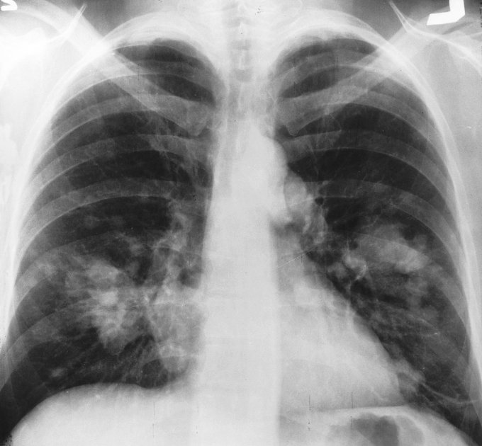 Radiographie d&apos;un thorax montrant un cancer pulmonaire :