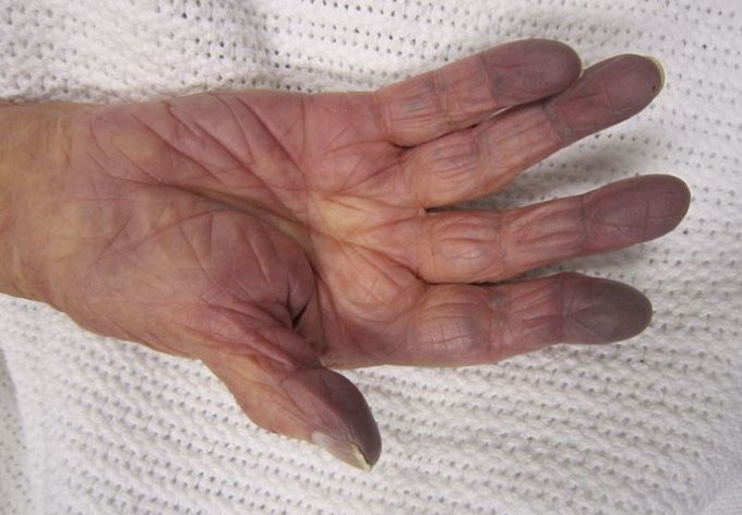 Photo : cyanose de la main d&apos;un patient avec une faible saturation en oxygène