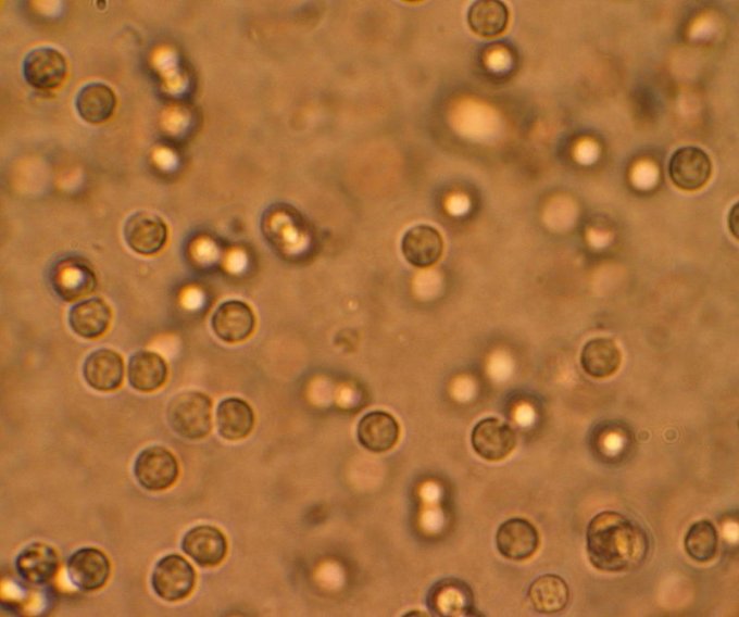 Photo : globules blancs dans l&apos;urine d&apos;un patient atteint d&apos;une infection urinaire