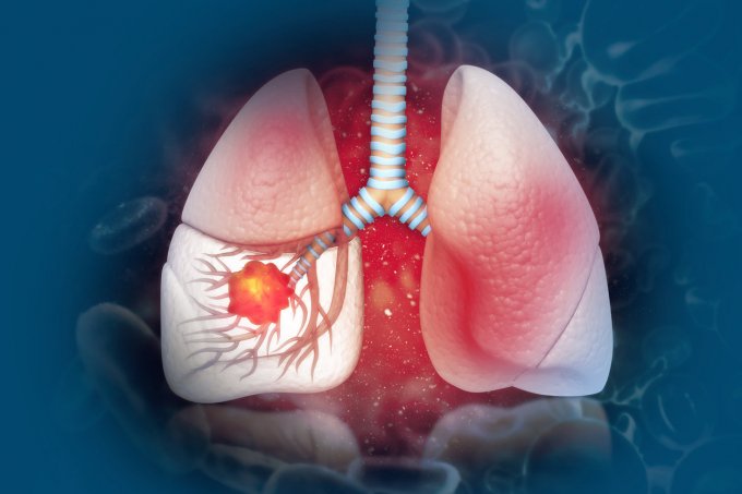 Cancer du poumon : sauriez-vous le reconnaître à temps ?