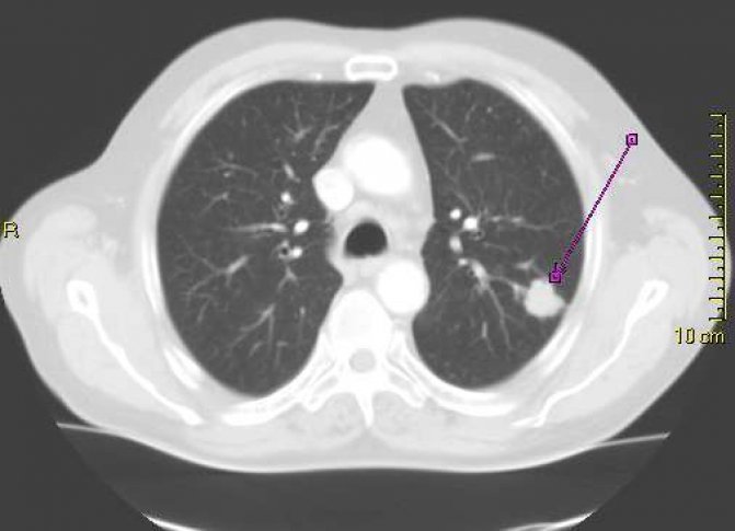 Photo : scanner d&apos;une tumeur cancéreuse dans le lobe supérieur du poumon gauche
