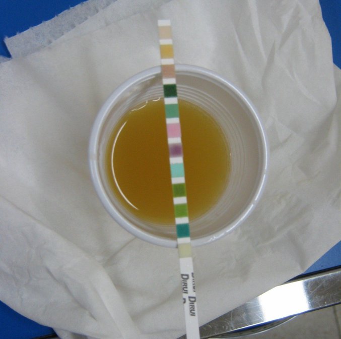 Analyse d&apos;urine : comment recueillir l’urine du nouveau-né ?