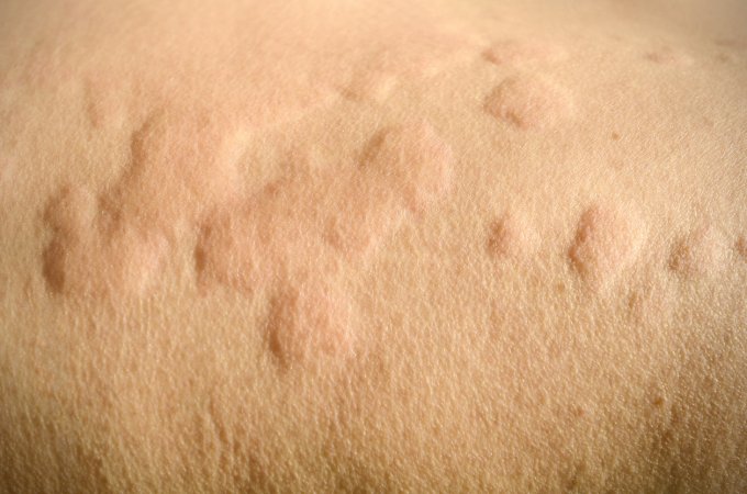 Nouvelle étude : les framboises noires prometteuses pour réduire l&apos;inflammation de la peau
