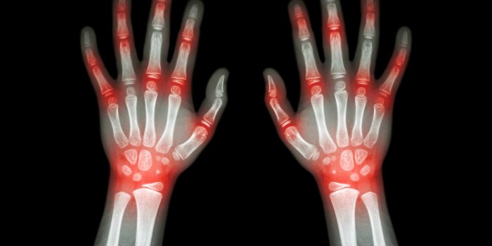 rheumatoid arthritis , gout arthritis ( film x-ray both hands of child with multiple joint arthritis ) ( medical , scienc...