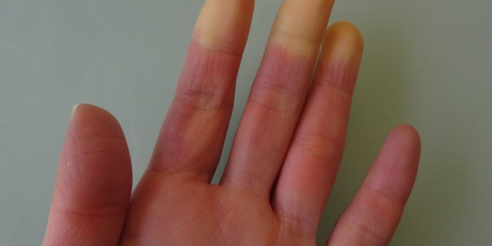 Maladie de Raynaud : les signes Ã  reconnaÃ®tre sur vos mains