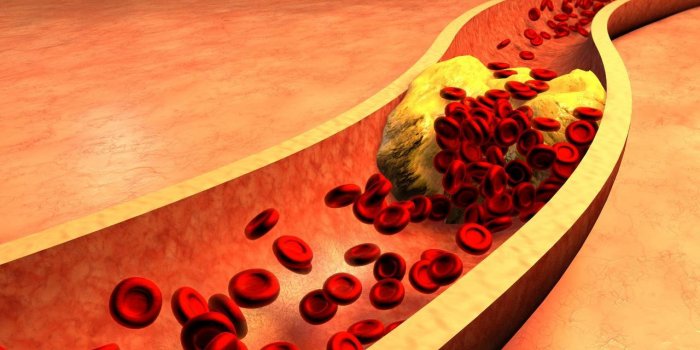 AVC et crise cardiaque : 5 signes de lâenfance qui prÃ©disent vos risques
