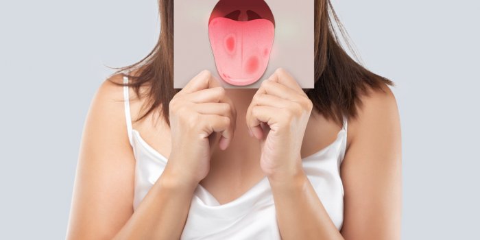the woman show the picture of tongue problems, illustration benign migratory glossitis on a brown paper, behcet's disease