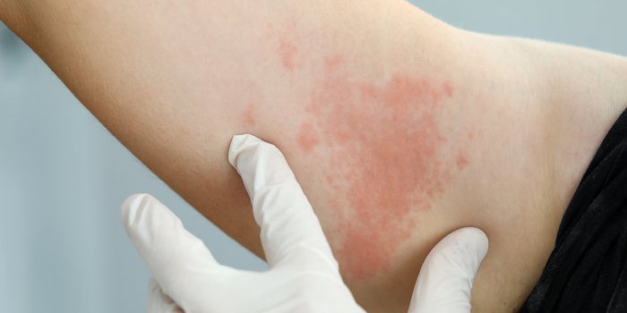 Allergie aux antibiotiques : 5 graves rÃ©actions Ã  connaÃ®tre 