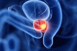 Cancer de la prostate : pourquoi le depistage organise n’est-il pas mis en place ?