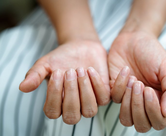 Melanome : ces signes sur vos ongles peuvent l’annoncer