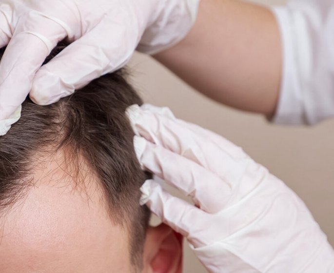 Perte de cheveux : avez-vous pense a la greffe capillaire ?