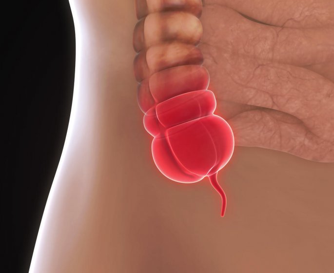 Appendicite : qu-est-ce qu-une peritonite appendiculaire ?