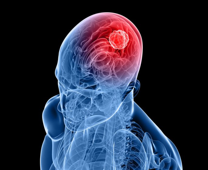 Tumeur cerebrale ou cancer du cerveau : qu-est-ce que c-est ?