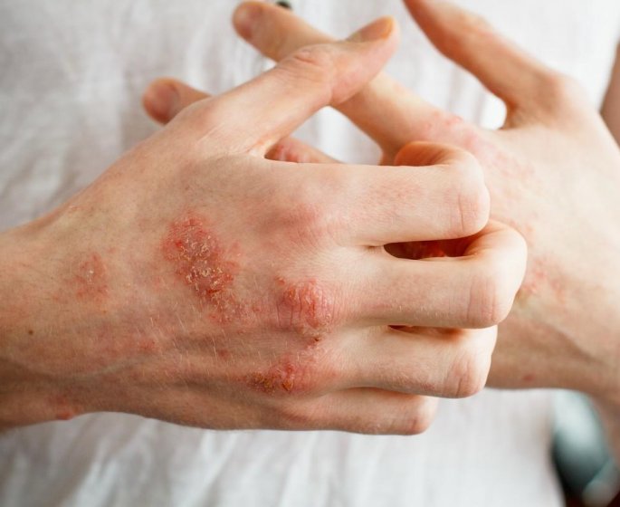 Allergies cutanees : un microbiote altere pourrait en etre la cause