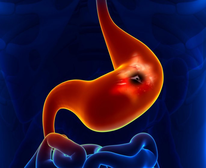 Ulcere gastrique : les risques