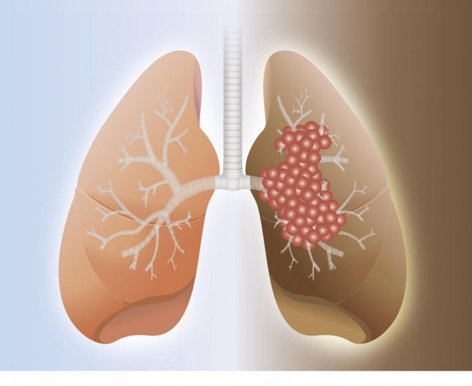 Recidive du cancer du poumon : les chances de survie
