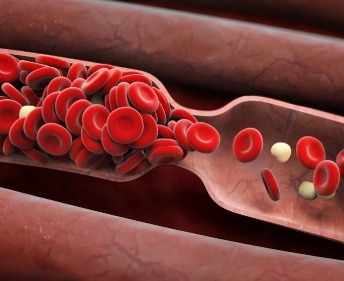 Exces de plomb dans le sang : la cause de cholesterol a laquelle on ne pense pas