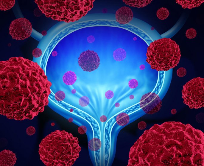 Cancer de la vessie : un risque d-infertilite chez la femme