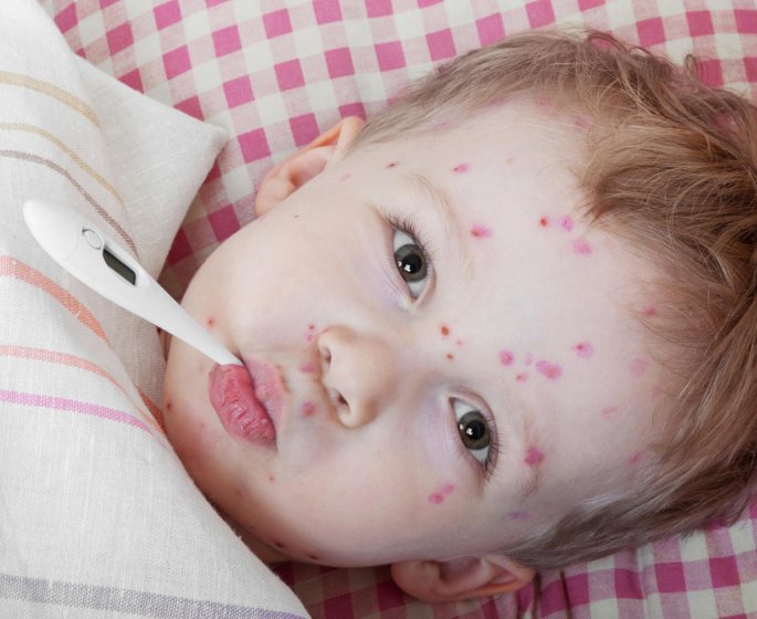Sante de bebe : le virus de la varicelle