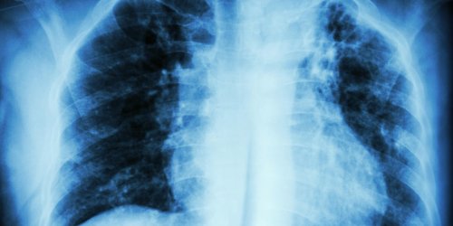 Tuberculose (pulmonaire, osseuse…) : symptomes, test, vaccin et traitements