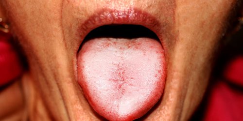 Cancer de la langue : symptomes, pronostic, traitements