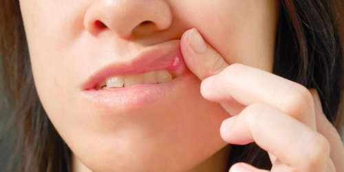 Bouton dans la bouche : aphte ou herpes, la difference