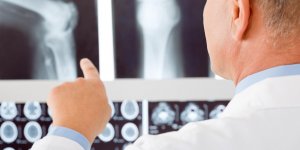 Osteoporose severe : la frequence chez l-homme