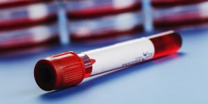 Bipolaire : peut-on detecter le trouble par un test sanguin ?