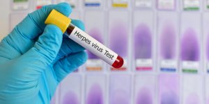 Herpes genital : un traitement naturel