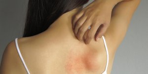 Allergie cutanee : a quoi ressemble une urticaire ?