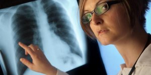 Cancer : les metastases pulmonaires