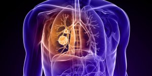 Cancer du poumon : le cancer le plus mortel