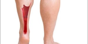 Rupture du tendon d-Achille : les causes