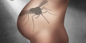 Pourquoi le virus Zika est responsable de microcephalie ?
