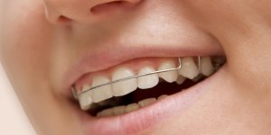 Dents : a quoi sert un faux palais ?