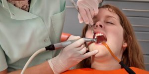 Le detartrage elimine la plaque dentaire