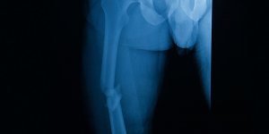 Fracture du femur : a partir de quel age ?