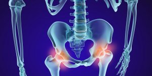 Col du femur : le traitement par osteosynthese par plaque