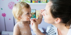 Varicelle de l-enfant : pourquoi utiliser une creme cicatrisante
