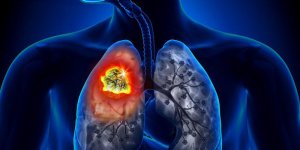 Ce gaz inodore dans votre maison qui augmente le risque de cancer du poumon