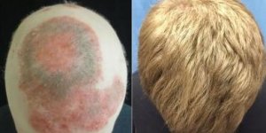 Un traitement etonnant fait repousser ses cheveux en 8 mois
